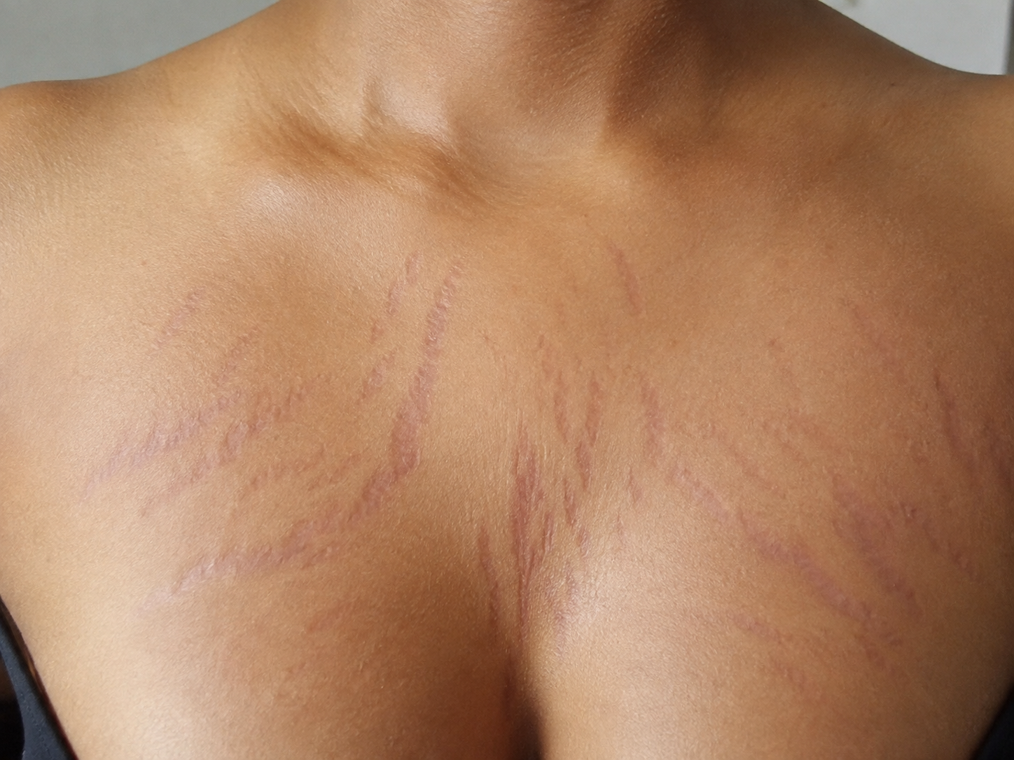 Chest Stretch Marks