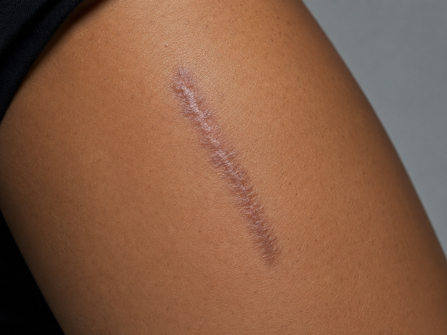 Scars