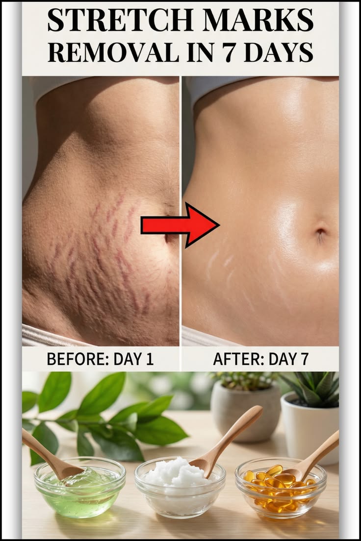 DR. MEINAIER Stretch Mark Cream