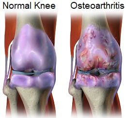 Inflammation and pain in the joints