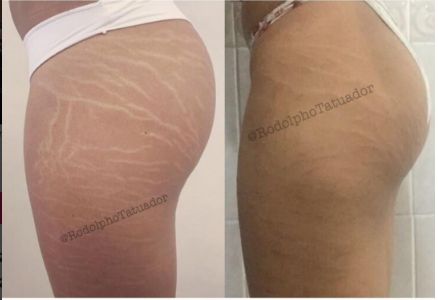 Bum Stretch Marks