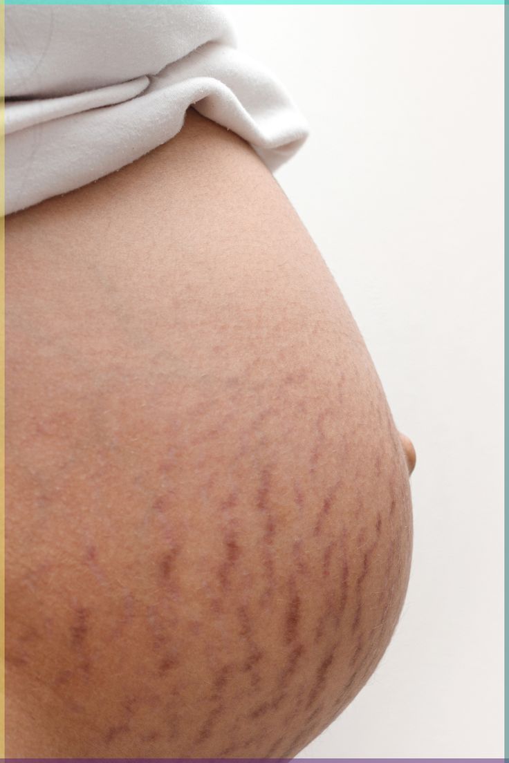 Pregnancy Stretch Marks