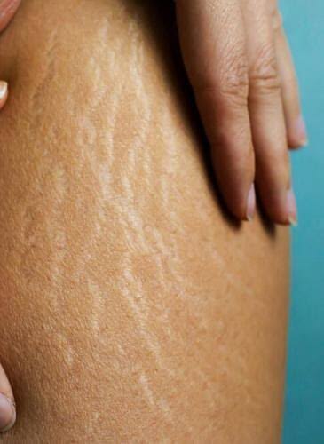 Thigh Stretch Marks